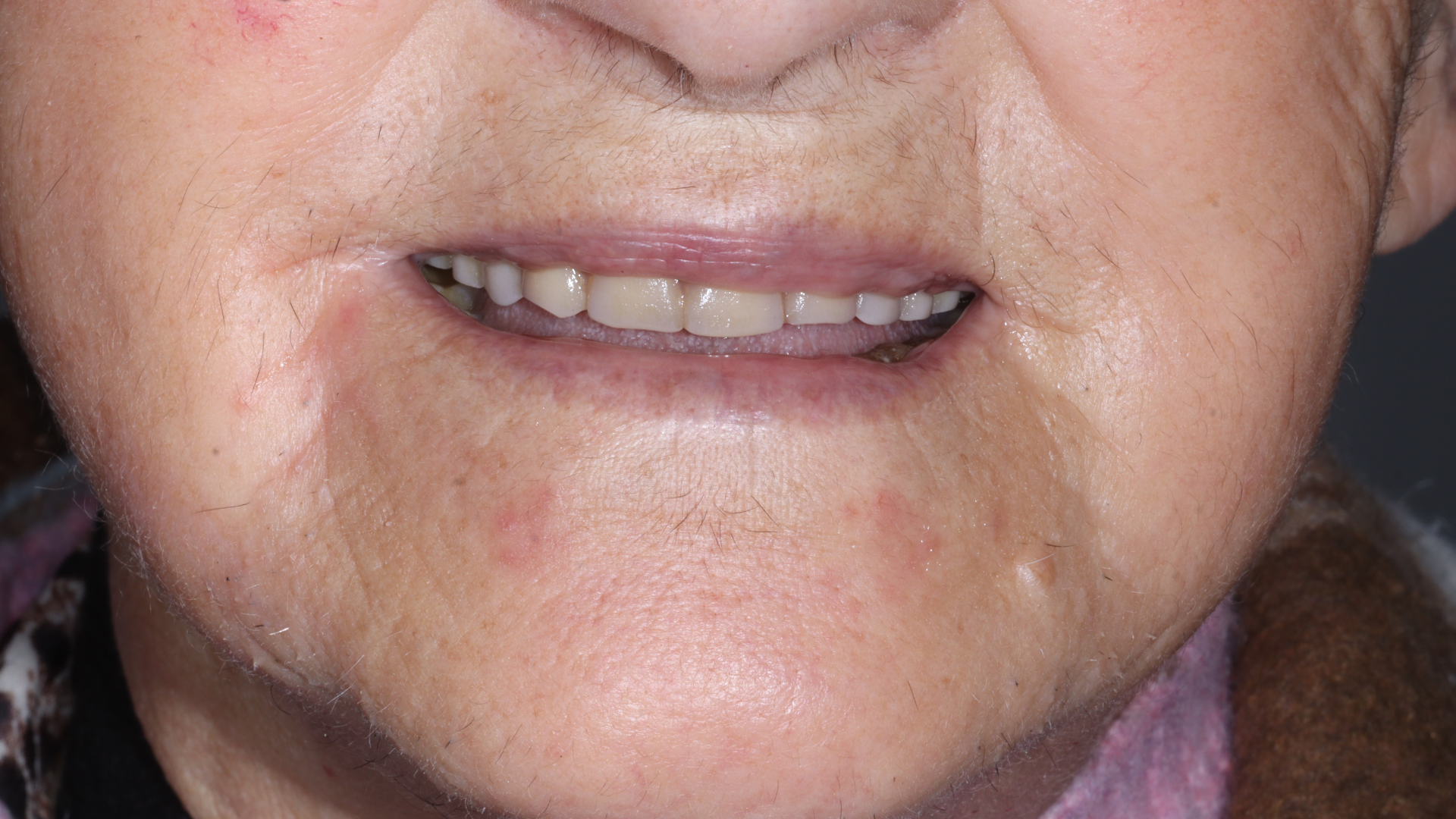 próteses removíveis próteses removíveis