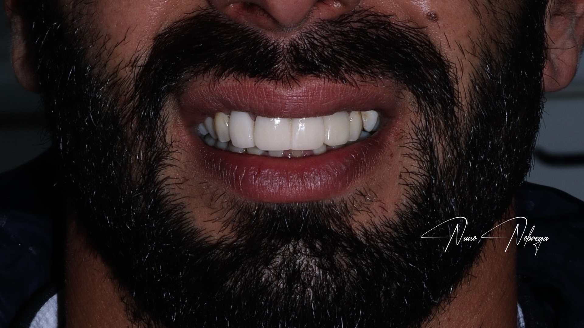 reabilitação oral fixa