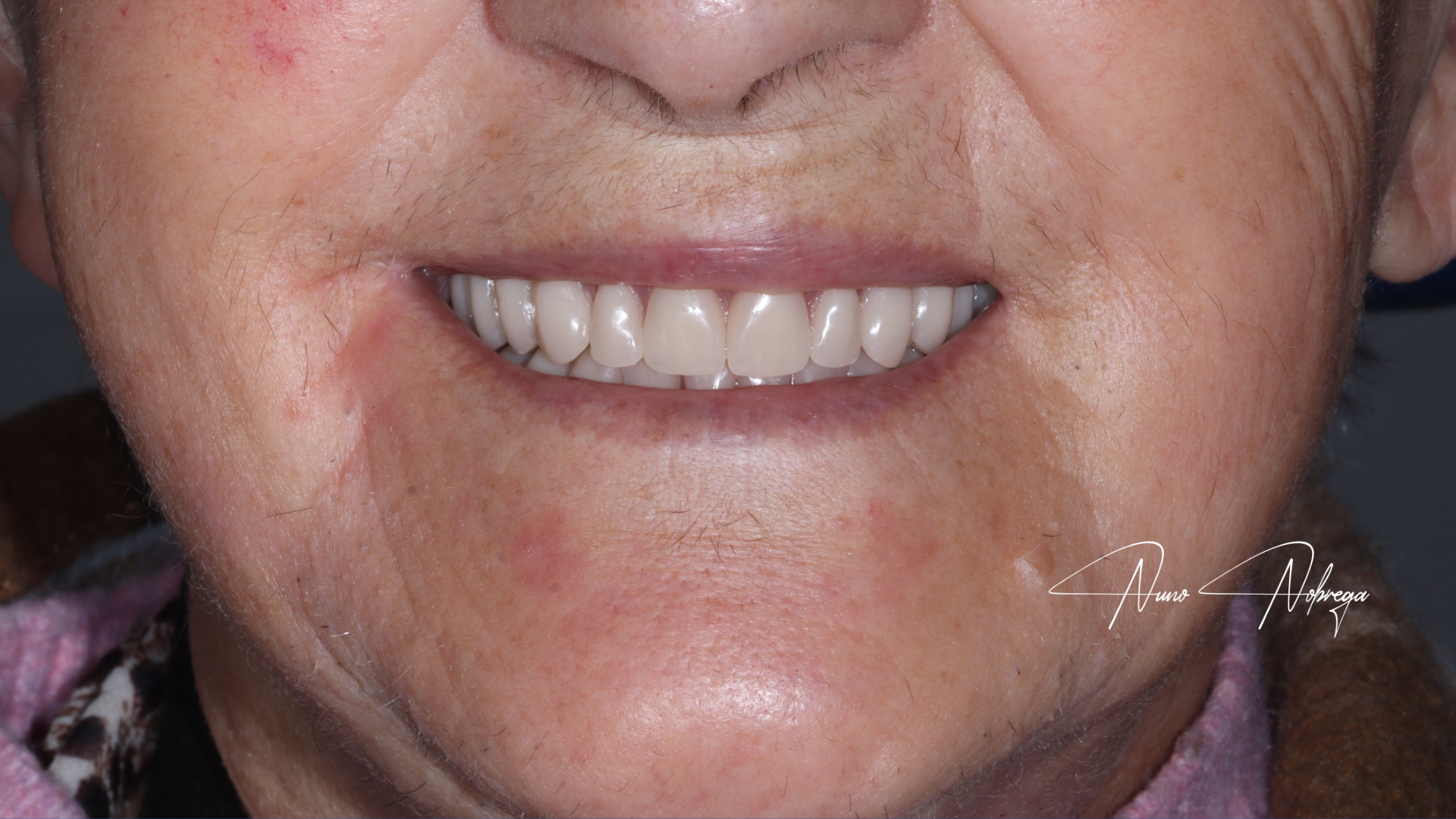 próteses removíveis